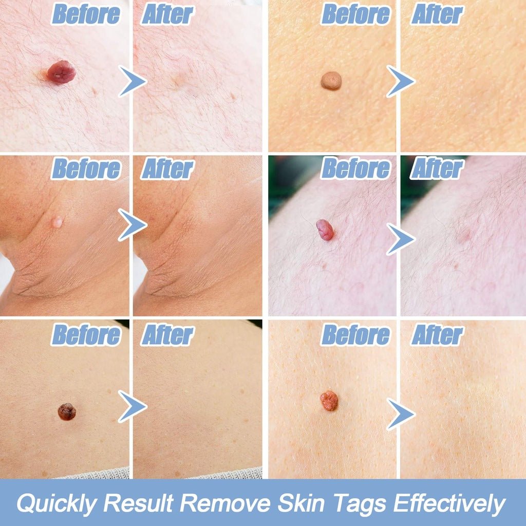 Skin Tag Removal Kit - Rarefinda.com